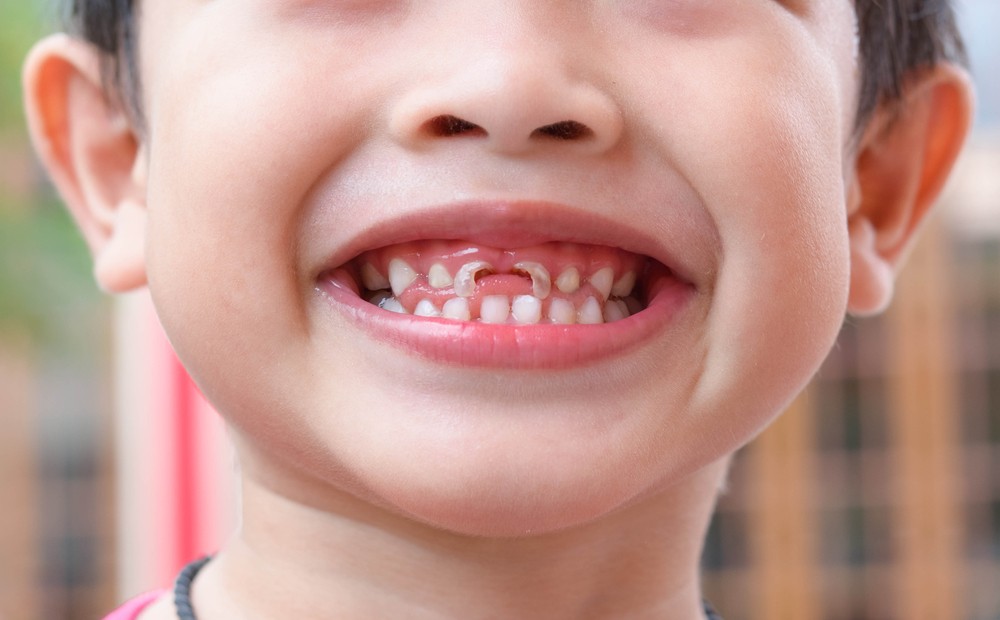 What do the FDA, Bottled Water & Tooth Decay Have in Common?